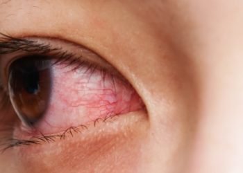 ചെങ്കണ്ണ് തെറ്റിദ്ധാരണകളും യാഥാര്ത്ഥ്യങ്ങളും