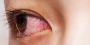 ചെങ്കണ്ണ് തെറ്റിദ്ധാരണകളും യാഥാര്‍ത്ഥ്യങ്ങളും