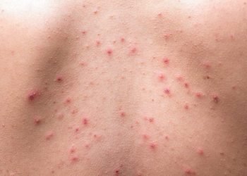 ചെറുപ്പക്കാരിലെ ചര്മ്മ രോഗ തെറ്റിദ്ധാരണകളും ചികിത്സാ രീതികളും