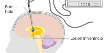 തലച്ചോറില്‍ ‘കീ ഹോള്‍ ശസ്ത്രക്രീയ’ ഫലപ്രദമോ?
