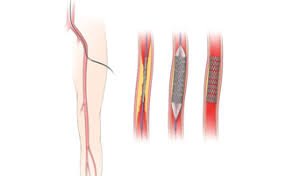 വാസ്‌കുലാര്‍ സര്‍ജറി ഫലപ്രദമോ?