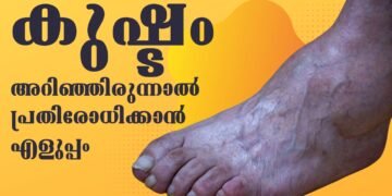 രോഗം ബാധിച്ചിട്ട് വേവലാതിപ്പെടാതെ രോഗത്തെയറിഞ്ഞ് പ്രതിരോധിക്കാം | #Leprosy #DoctorLive