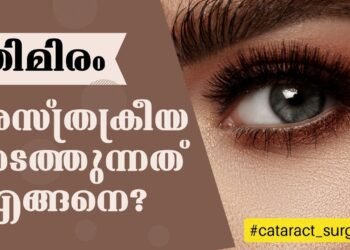 Cataract Surgery