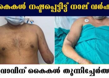 Hand Replacement Surgery