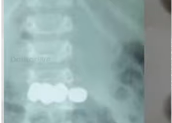 രണ്ടുവയസ്സുകാരൻ വിഴുങ്ങിയത് അഞ്ചുബാറ്ററികൾ,  ജീവൻ രക്ഷിച്ച് ഡോക്ടർമാർ