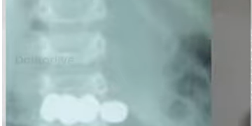 രണ്ടുവയസ്സുകാരൻ വിഴുങ്ങിയത് അഞ്ചുബാറ്ററികൾ,  ജീവൻ രക്ഷിച്ച് ഡോക്ടർമാർ