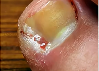 കുഴിനഖങ്ങൾ എങ്ങനെ തടയാം