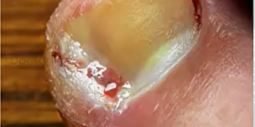 കുഴിനഖങ്ങൾ എങ്ങനെ തടയാം