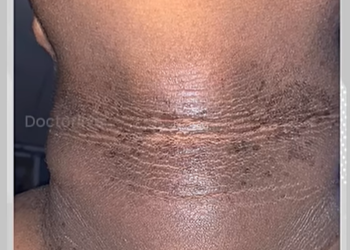 കഴുത്തിന് ചുറ്റും കറുപ്പ് കാണപ്പെടുന്നത്