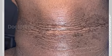 കഴുത്തിന് ചുറ്റും കറുപ്പ് കാണപ്പെടുന്നത്