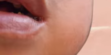 ജില്ലയിൽ മുണ്ടിനീര് വ്യാപിക്കുന്നതായി റിപ്പോർട്ട്