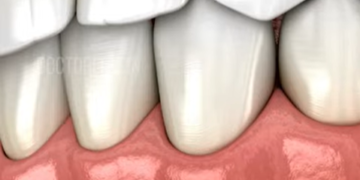 ഇനാമൽ നഷ്ടമാകുന്നതിന്റെ ലക്ഷണങ്ങൾ