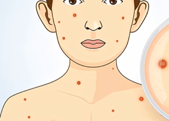 ചിക്കൻ പോക്‌സിനെതിരെ  ജാഗ്രതാ നിർദേശവുമായി ആരോഗ്യ വകുപ്പ്