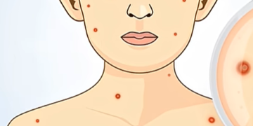 ചിക്കൻ പോക്സിനെതിരെ ജാഗ്രതാ നിർദേശവുമായി ആരോഗ്യ വകുപ്പ്